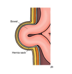 Incisional Hernia is the protrusion of bowel or fat through an area of weakness in the scar from an operation on the abdominal wall.